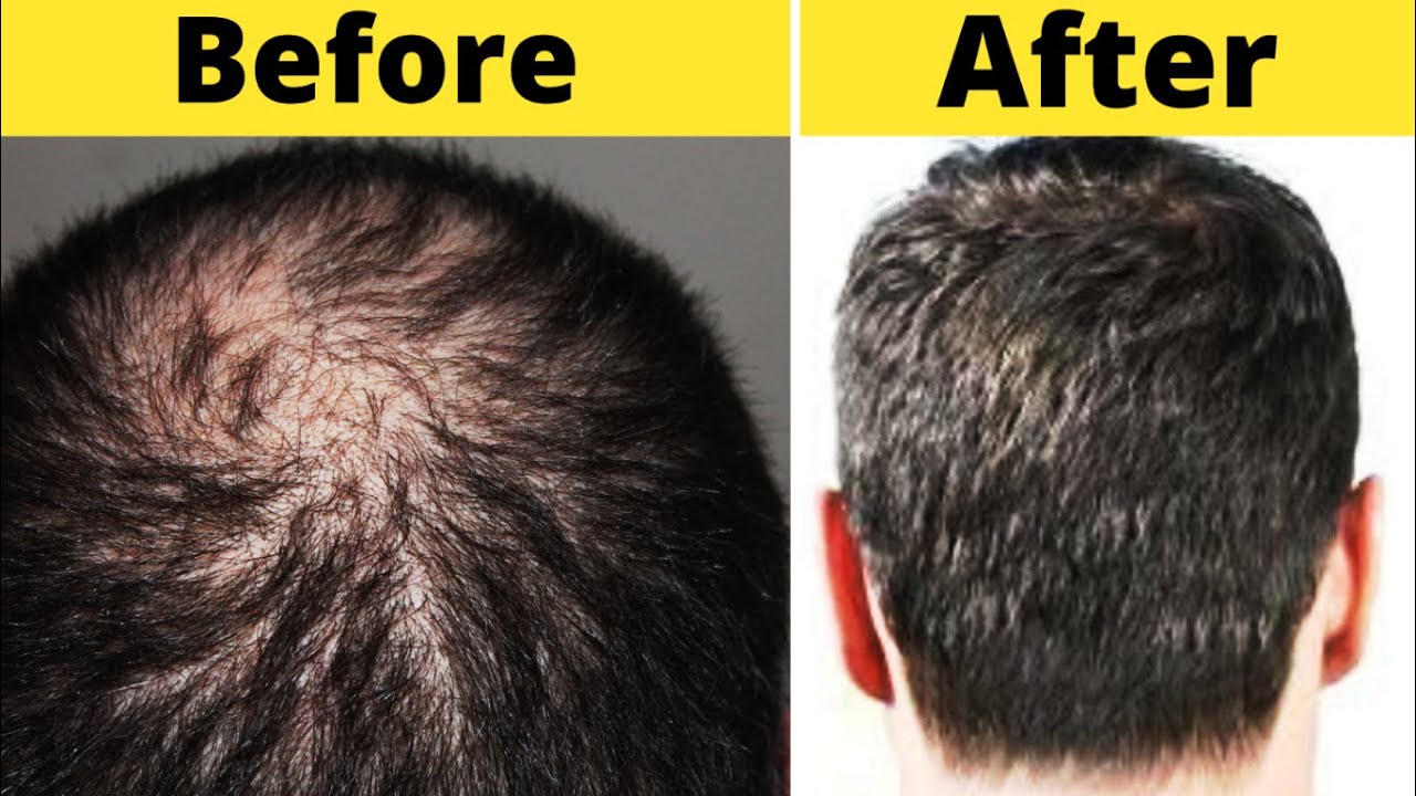 Image showcasing Hair Loss Treatment For Men Naturally With 5 Simple Home Remedies ...