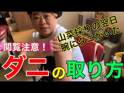 【閲覧注意】ダニの取り方！モリ夫の腕にダニが食い込んでた！