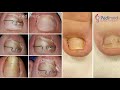 Wrastające paznokcie – przyczyny, objawy i sposoby leczenia w Klinice Podologii w Pedimed w Krakowie