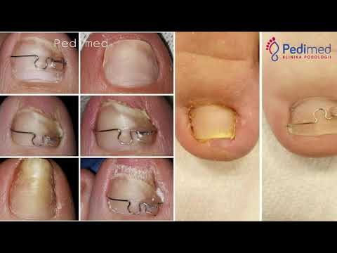 Wrastające paznokcie – przyczyny, objawy i sposoby leczenia w Klinice Podologii w Pedimed w Krakowie