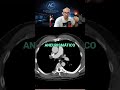 Diferentes morfologías que podría tener el tronco de la arteria pulmonar.