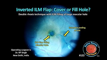 RetinaRounds™ 122: Inverted ILM Flap: Cover or Fill the Macular Hole?