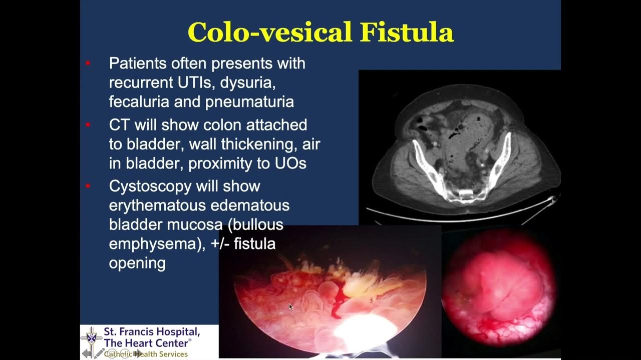 bad-connections-colovesical-colocutaneous-vaginal-fistula-due-to