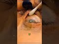 Still Sleeping with Contact Lenses? See What Happened to This Woman #eyes #dangerous #contactlenses