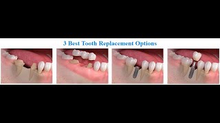 What Happens When you Don't Replace Missing Teeth?
