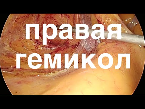 расширенная правосторонняя гемиколэктомия // лапароскопическая гемиколэктомия // right hemicolectomy