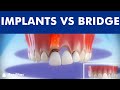 Dental implants vs tooth bridge  comparison 