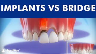 Dental Implants VS Tooth bridge  Comparison ©