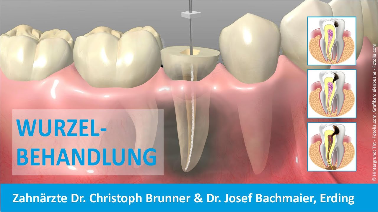 Wurzelbehandlung Zahnarzt Erding Dr. Christoph Brunner & Dr. Josef