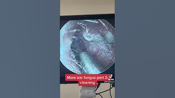 Thumbnail of Cleaning ear fungus (otomycosis). #lastofus