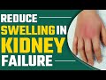 Tips to Reduce Swelling in Kidney Failure | Bharat Homeopathy