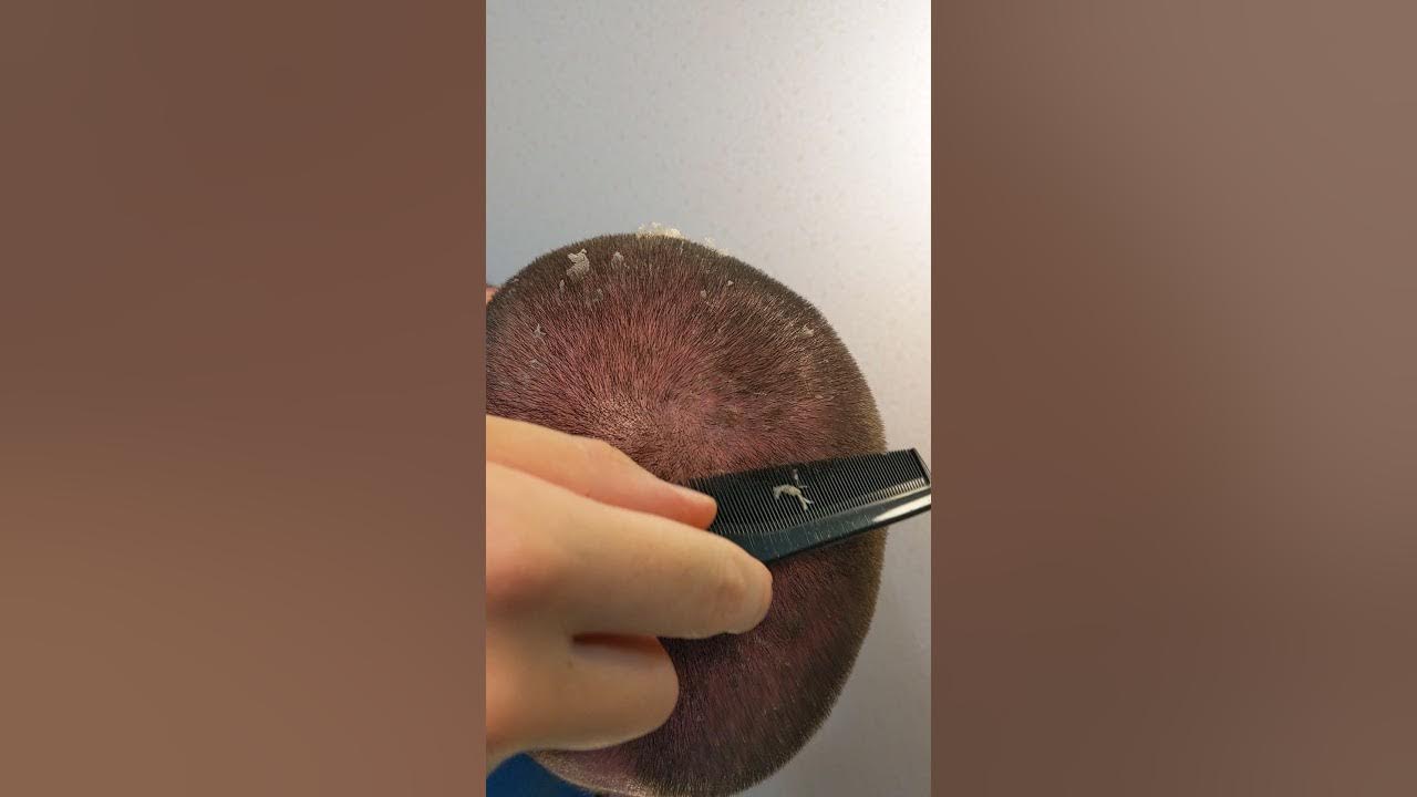 Scalp burn peeling YouTube