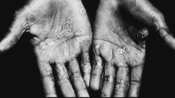 Monkeypox declared global emergency by World Health Organization | What to know