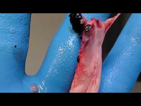 White clots USA, Part 2