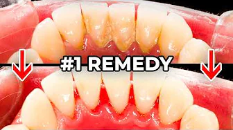 The #1 Remedy to Prevent Tartar (Most People Skip This!)