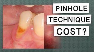 How Much Does The Pinhole Technique Cost? Gum Recession Q&A With Dr. Nemeth