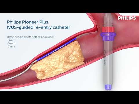 Identify true lumen - Philips Pioneer Plus IVUS-guided Re-entry Catheter