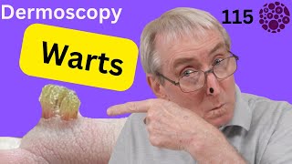 The Dermoscopy and management of viral warts in General Practice