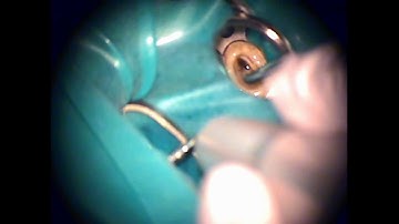 Removal of a nonvisible broken TFRK-12 tip beyond the severe curve