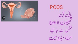 polycystic ovarian syndrome/ what are the symptoms of PCOs/ its treatment in Urdu