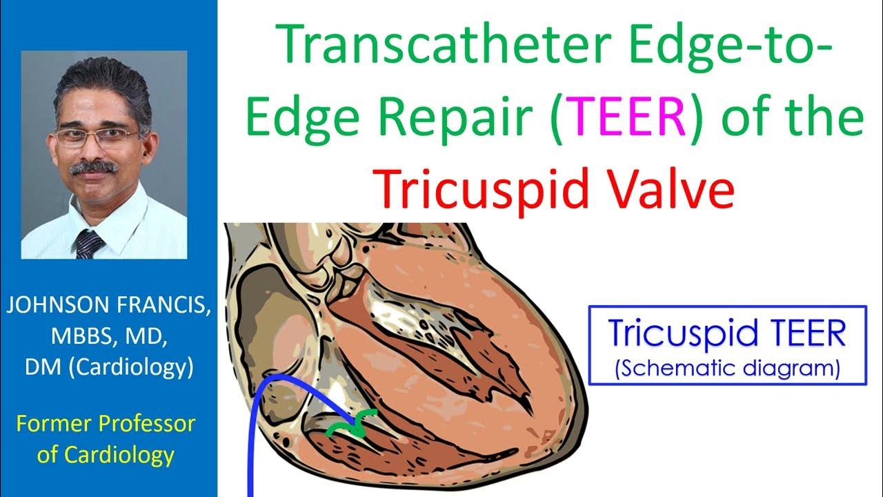 Transcatheter Edge To Edge Repair Teer Of The Tricuspid Valve Youtube