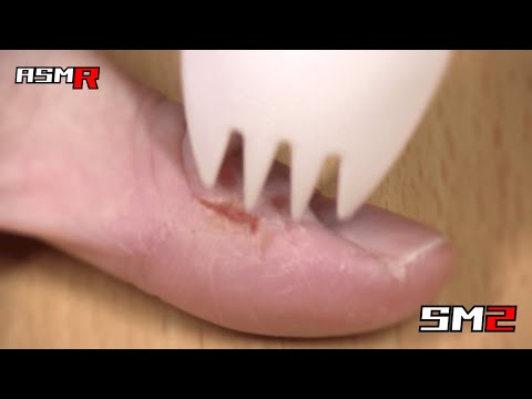 【聞くだけで気持ちが良い★アトピー性皮膚炎ASMR】超痒い親指をプラ製フォークスプーンで掻く音/癒し/リラックス効果/睡眠導入/マッサージ