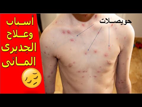 مرض الجديري المائي : اسبابه واعراضه 📝 وروشتة علاج 🤔👌والوقاية منه