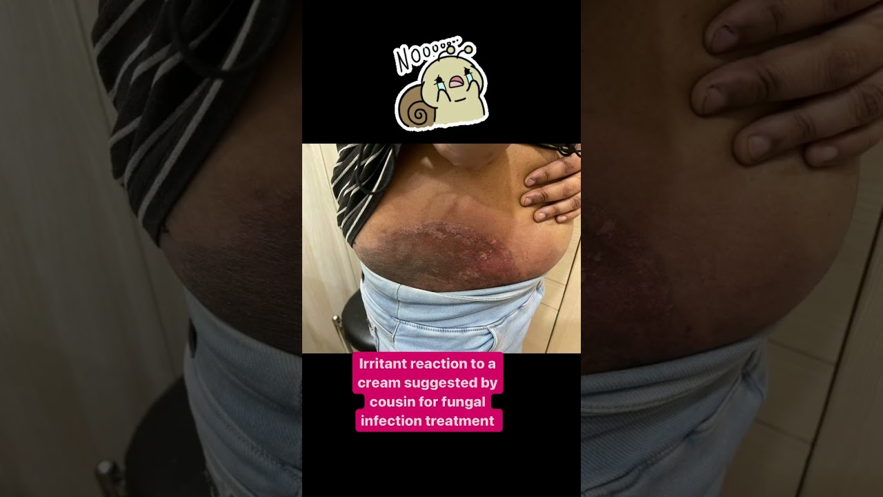 Are you using Derobin cream?| fungal infection treatment | Irritant reaction #drashimagoel #skincare