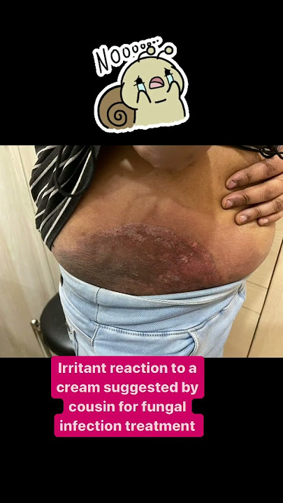 Are you using Derobin cream?| fungal infection treatment | Irritant reaction #drashimagoel #skincare