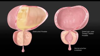 BPH 3 - surgical treatment for prostate enlargement