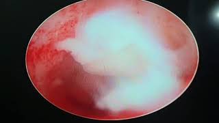 uterine fibroid myoma excluding استئصال ليف رحمي تنظير باطن رحم