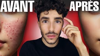 Acné 5 Astuces Validées Par La Science - Skincarebysamy