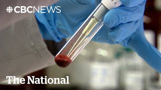 Stage 4 Prostate Cancer Cases Increased After Reduction In Psa Screening, Research Suggests