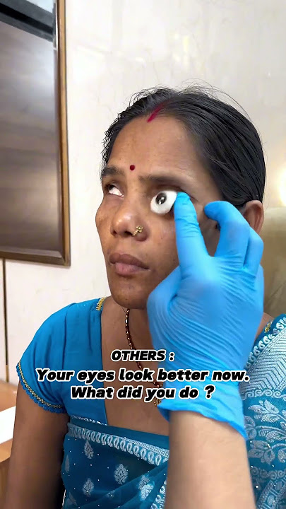 Oops!! What just happened here?!! #artificialeye #prostheticeye #ocularprosthesis #losteyetreatment