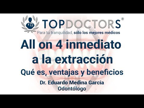 Técnica All on 4: El mejor procedimiento para recuperar todos los dientes