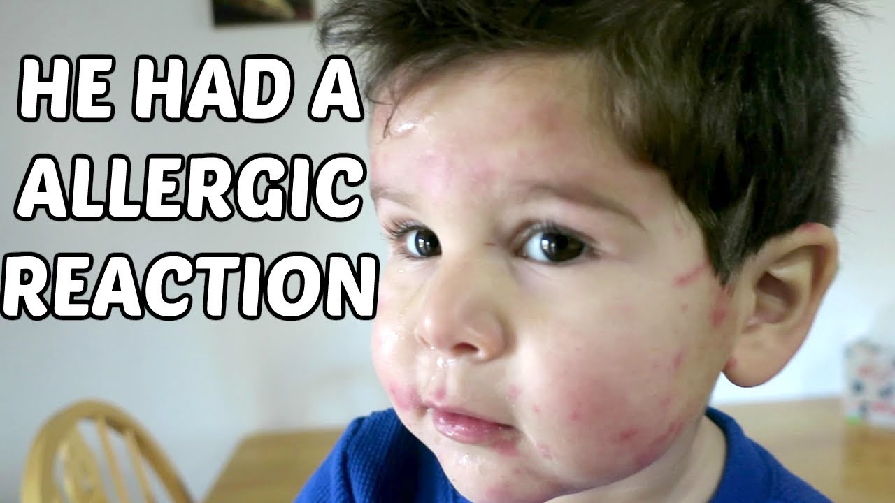 MY BABY HAD AN ALLERGIC REACTION! YouTube