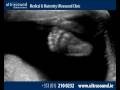 Pregnancy Ultrasound | Dublin, Ireland | www.ultrasound.ie