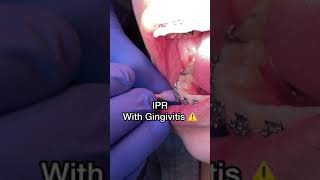IPR with Gingivitis - Tooth Time Family Dentistry