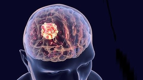 Brain Cancer and Its Impacts on Health (2 Minutes Microlearning)