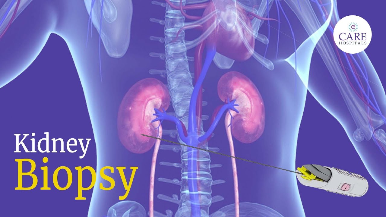 Kidney Biopsy How It Is Done I Kidney Biopsy After Transplant I YouTube kidney-biopsy-how-it-is-done-i-kidney-biopsy-after-transplant-i-youtube