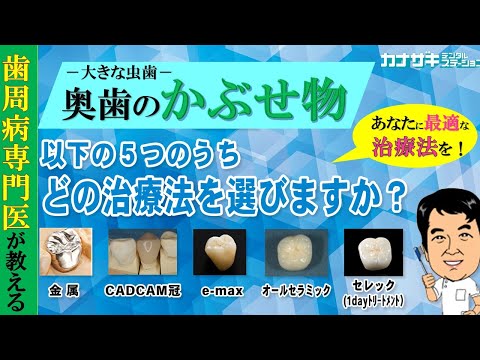 【大きな虫歯】奥歯のかぶせ物　おすすめの治療方法