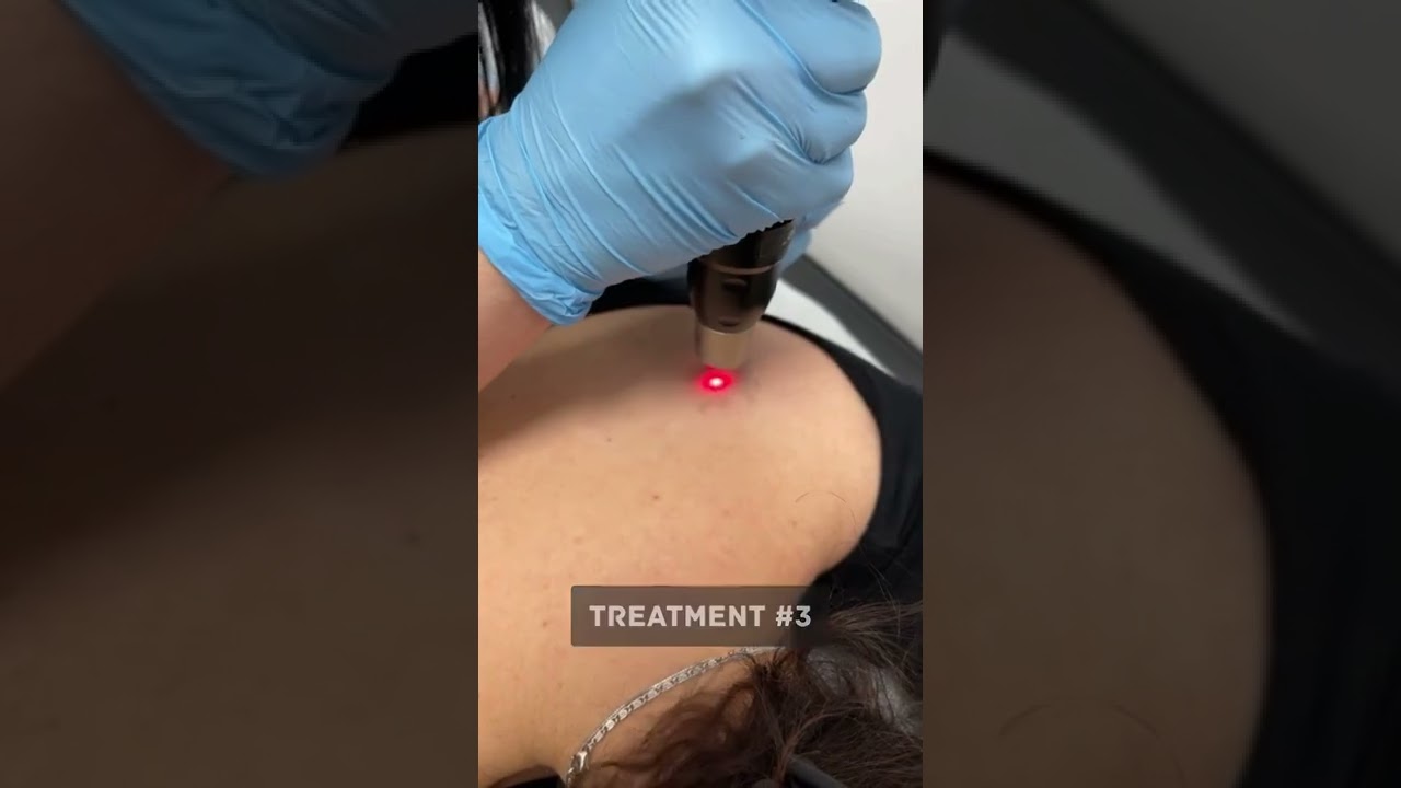 Tattoo removal using the PicoSure Laser Before & After