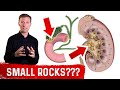 Why Do Stones Develop In Your Kidney and Gallbladder?