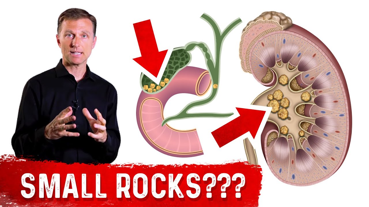 Why Do Stones Develop in Your Kidney and Gallbladder