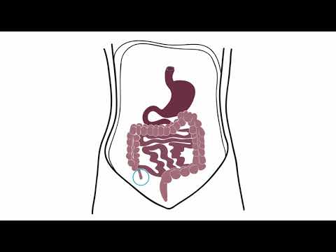 Video: Appendicitis - Ordliste Over Medicinske Termer