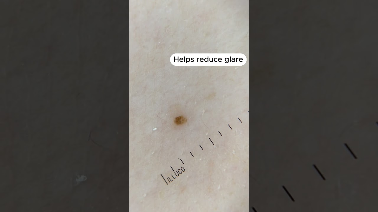 Mole check with Dermatoscope 