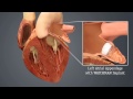 HCA Virginia – WATCHMAN Video 2: Left Atrial Appendage Closure Device