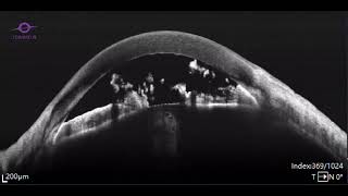Iridoschisis UBM versus 3D SS-OCT, TowardPi BMizar 400KHz speed Swept Source OCT system