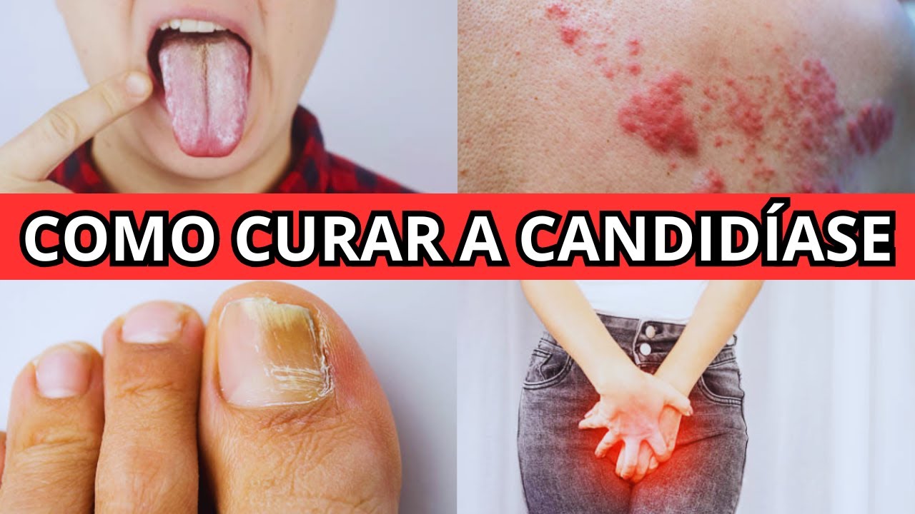 7 REMÉDIOS CASEIROS para ACABAR COM A CANDIDÍASE para SEMPRE! COMO ...