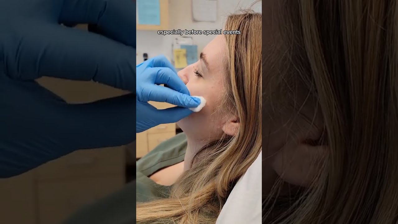 HOW TO How A Dermatologist Gets Rid Of Painful Acne Cyst In 48 Hours 